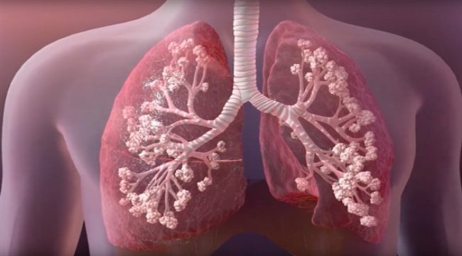 Koronavirüs sürecinde kistik fibrozis hastaları büyük risk altında