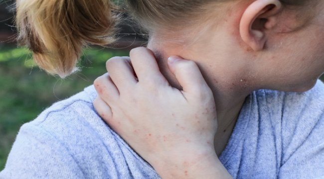 14 Eylül Dünya Atopik Dermatit Günü
