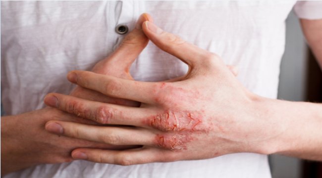 14 Eylül Dünya Atopik Dermatit Günü