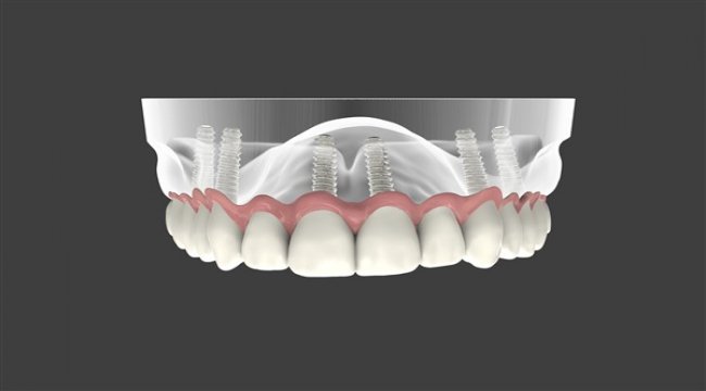 Diş implantları sizin için uygun mu?