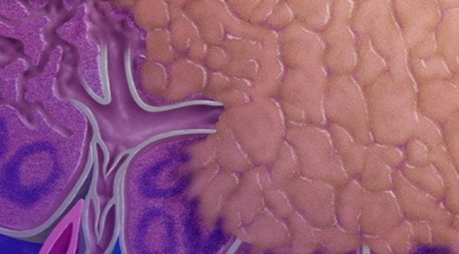 There are lymphoma clinical trials that are available for enrollment