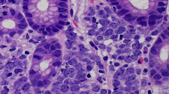 B-cell lymphoma clinical trials