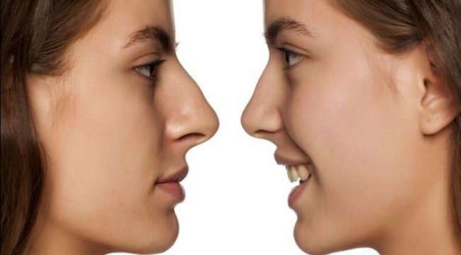 Burun estetiği sonrası nefes alma problemine dikkat