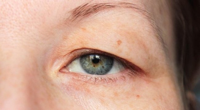 Göz kapak problemlerine dikkat