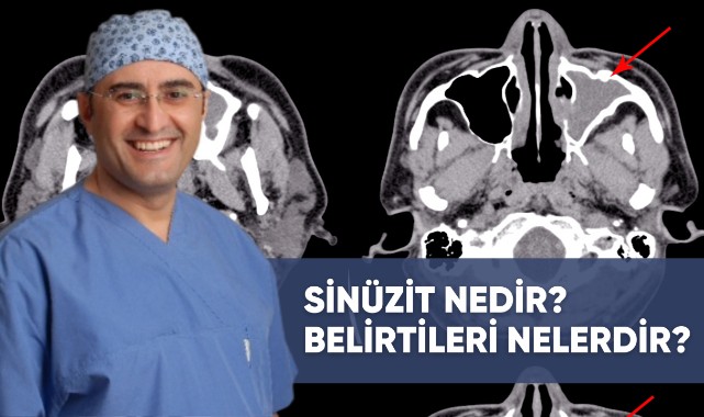 SİNÜZİT NEDİR ? BELİRTİLERİ NELERDİR?